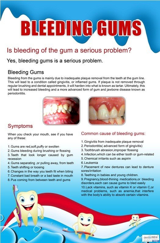 Poster English Is Bleeding Gums A Serious Problem - 042 - Libral Traders