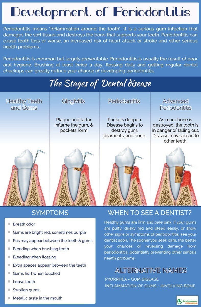 Poster English Development of Periodontitis - 090 - Libral Traders
