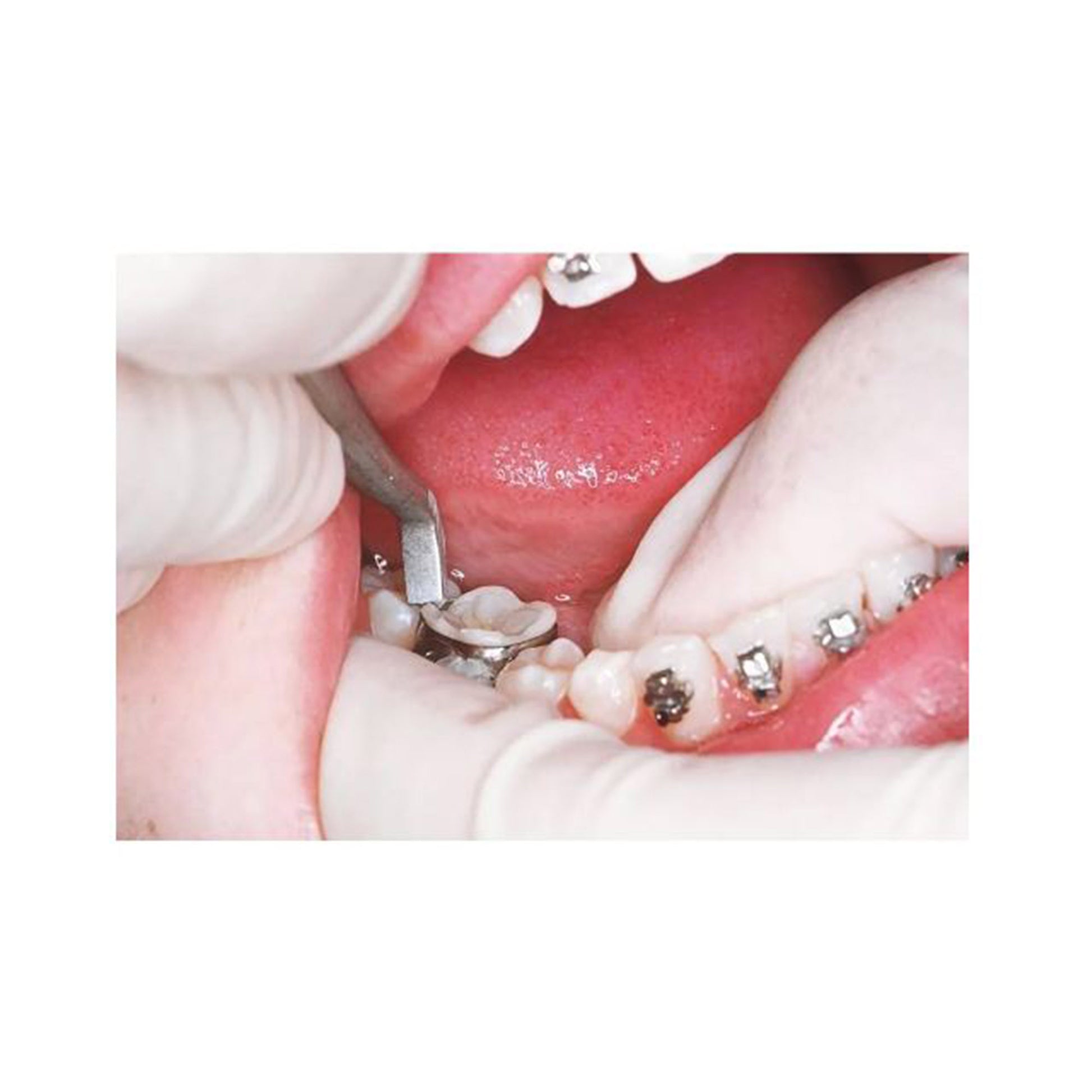 YDM Aligner Horizontal Plier - Libral Traders