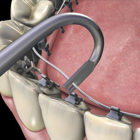 CAT Lingual Wire Tucker U Shape - Libral Traders