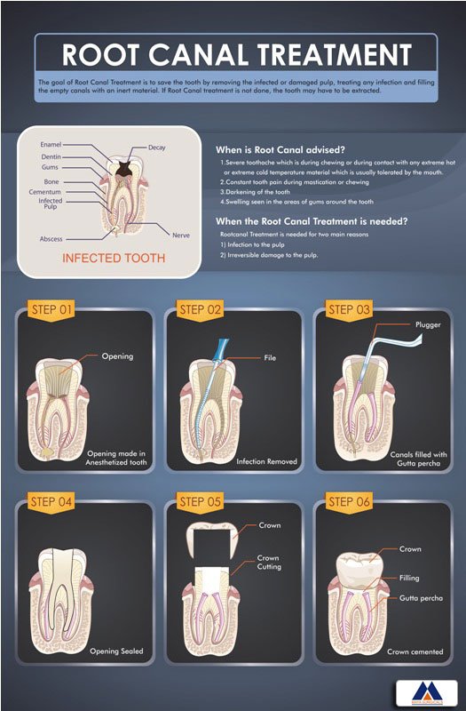 Poster English Root Canal Treatment - 030 - Libral Traders