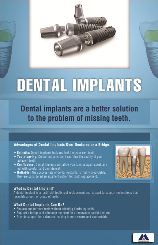 Poster English Dental Implants - 032 - Libral Traders