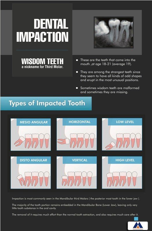Poster English Dental Impaction - 034 - Libral Traders