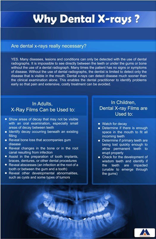 Poster English Why Dental X-ray - 041 - Libral Traders