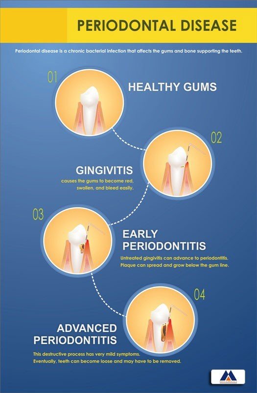 Poster English Periodontal Disease - 057 - Libral Traders