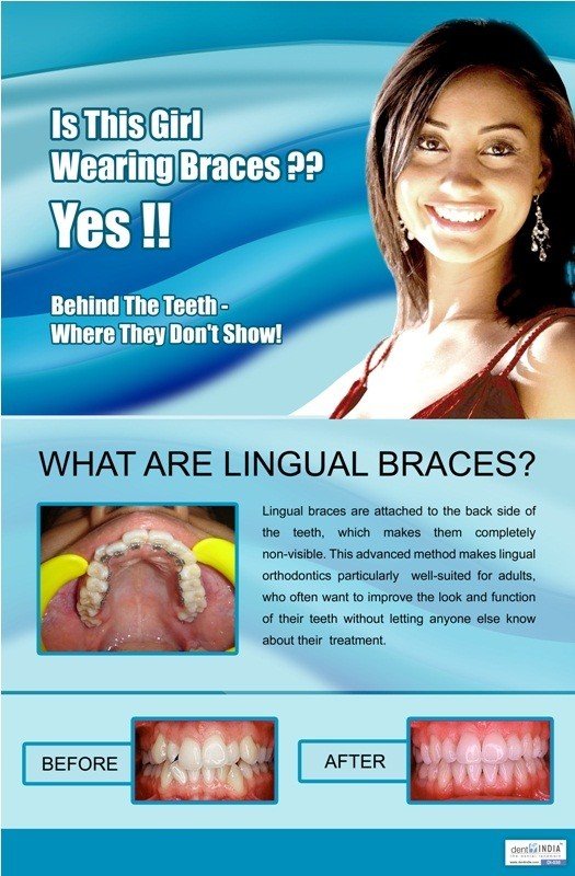Poster English Orthodontic Lingual Braces - 038 - Libral Traders
