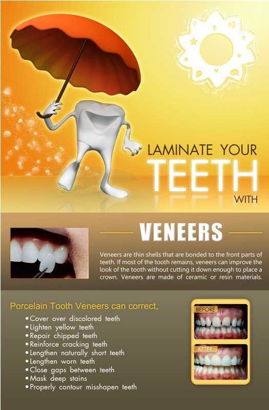 Poster English Laminate Your Teeth with Veneers - 046 - Libral Traders