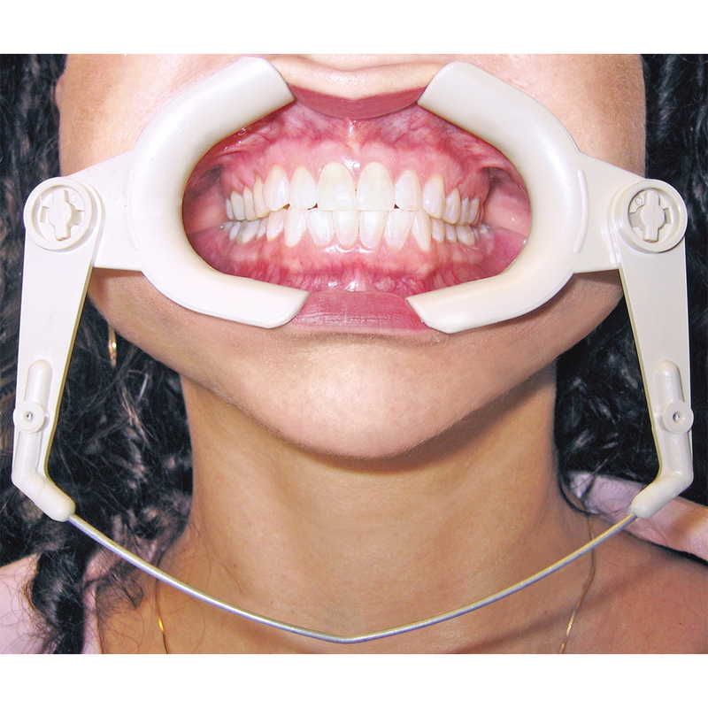 Large Captain Cheek and Tongue Retractors by Captain Orthodontics with flexible spring wire for orthodontic procedures.