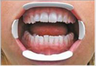 Captain Orthodontics Captain 3D Cheek and Tongue Retractor showing a clear plastic mouth retractor for orthodontic procedures