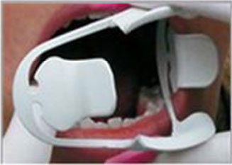 Captain Orthodontics Captain 3D Cheek and Tongue Retractor showing a clear, ergonomic design for dental procedures.