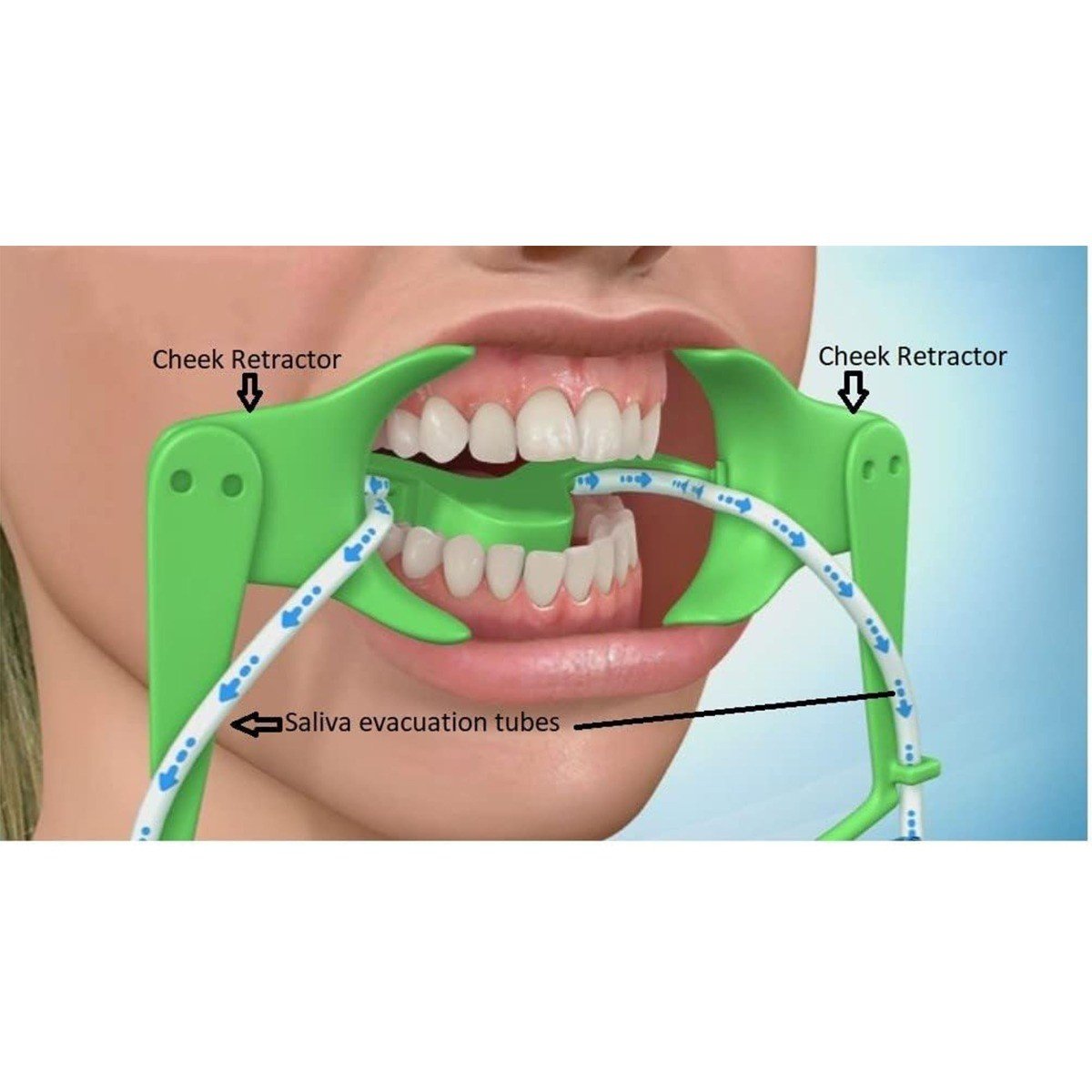 Captain Orthodontics Captain Dry Field System Cheek and Tongue Retractors for orthodontic procedures