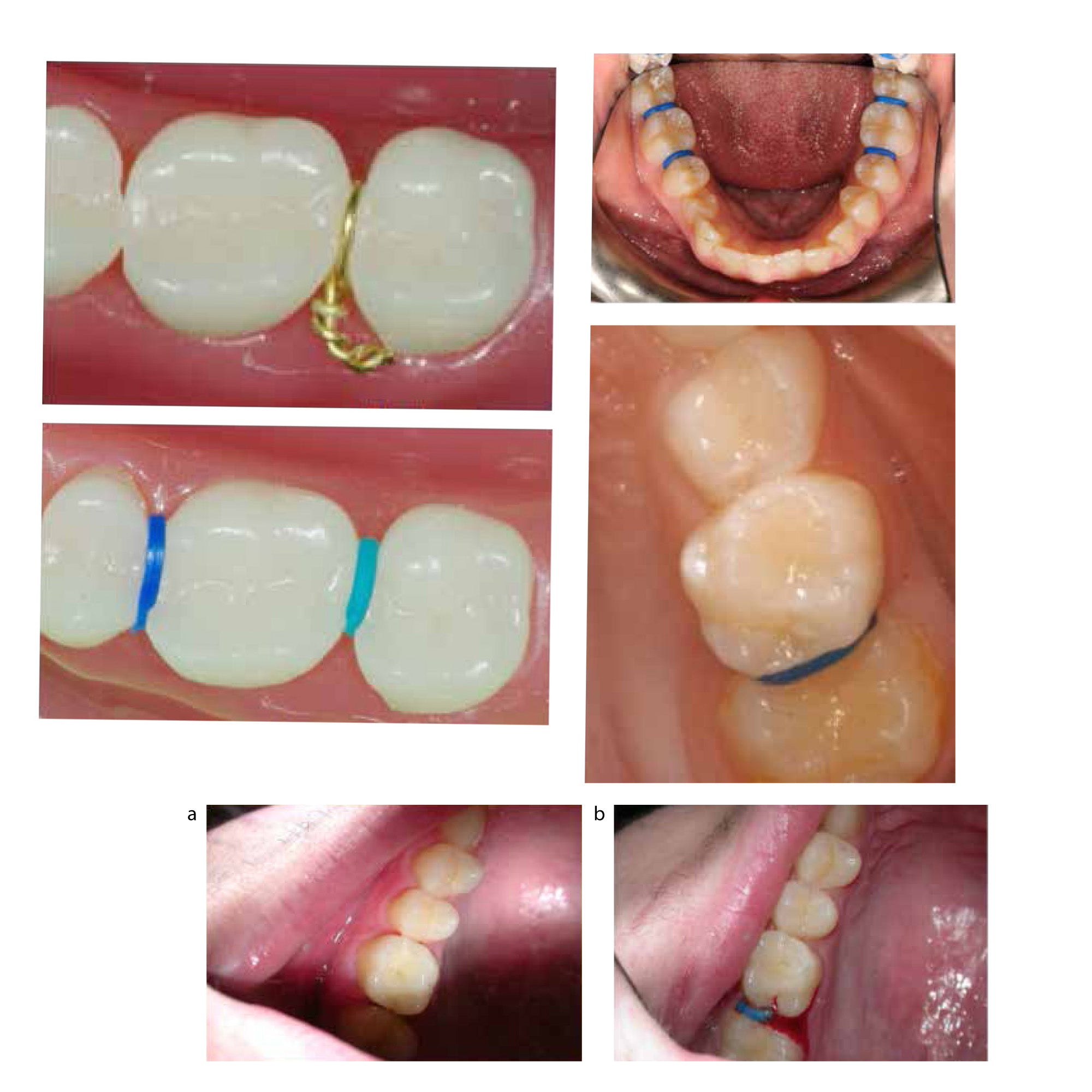 Captain Elastomeric Sticks Separators used in orthodontics, shown in a close-up of colorful elastic separators on teeth.