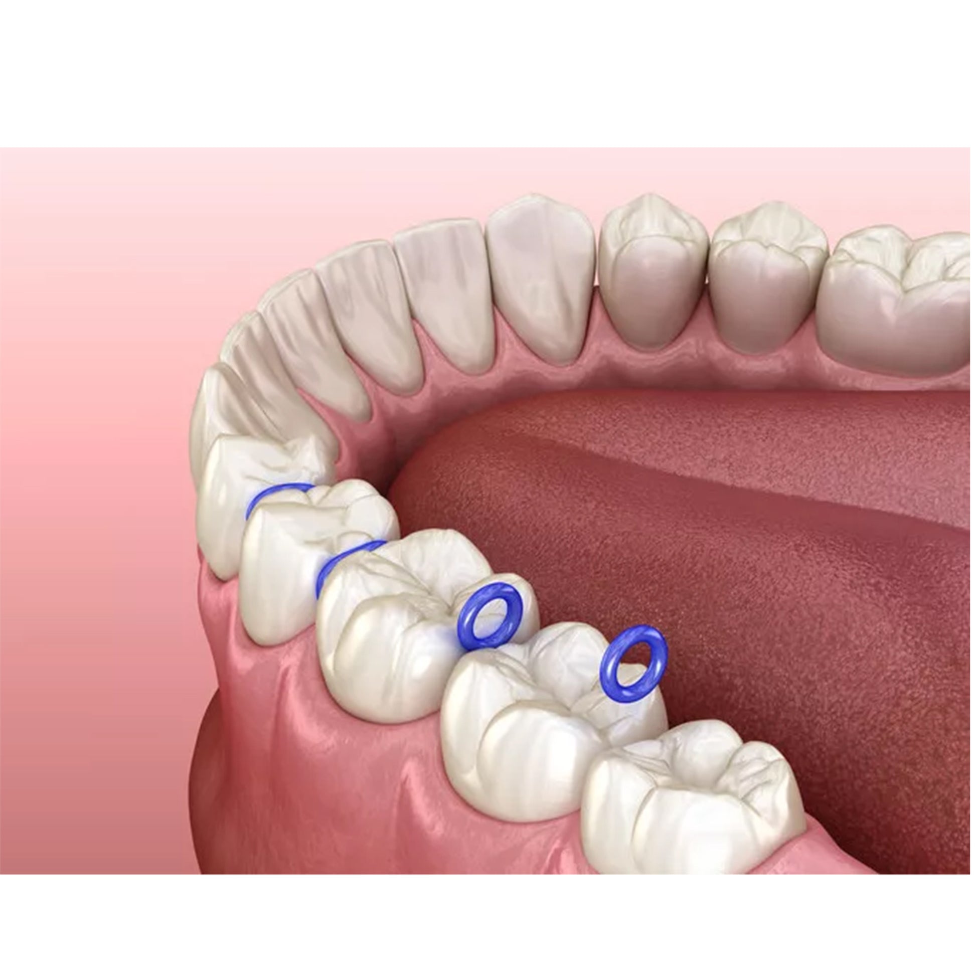 Captain Orthodontics Elastomeric Sticks Separators used for spacing between teeth during orthodontic treatment