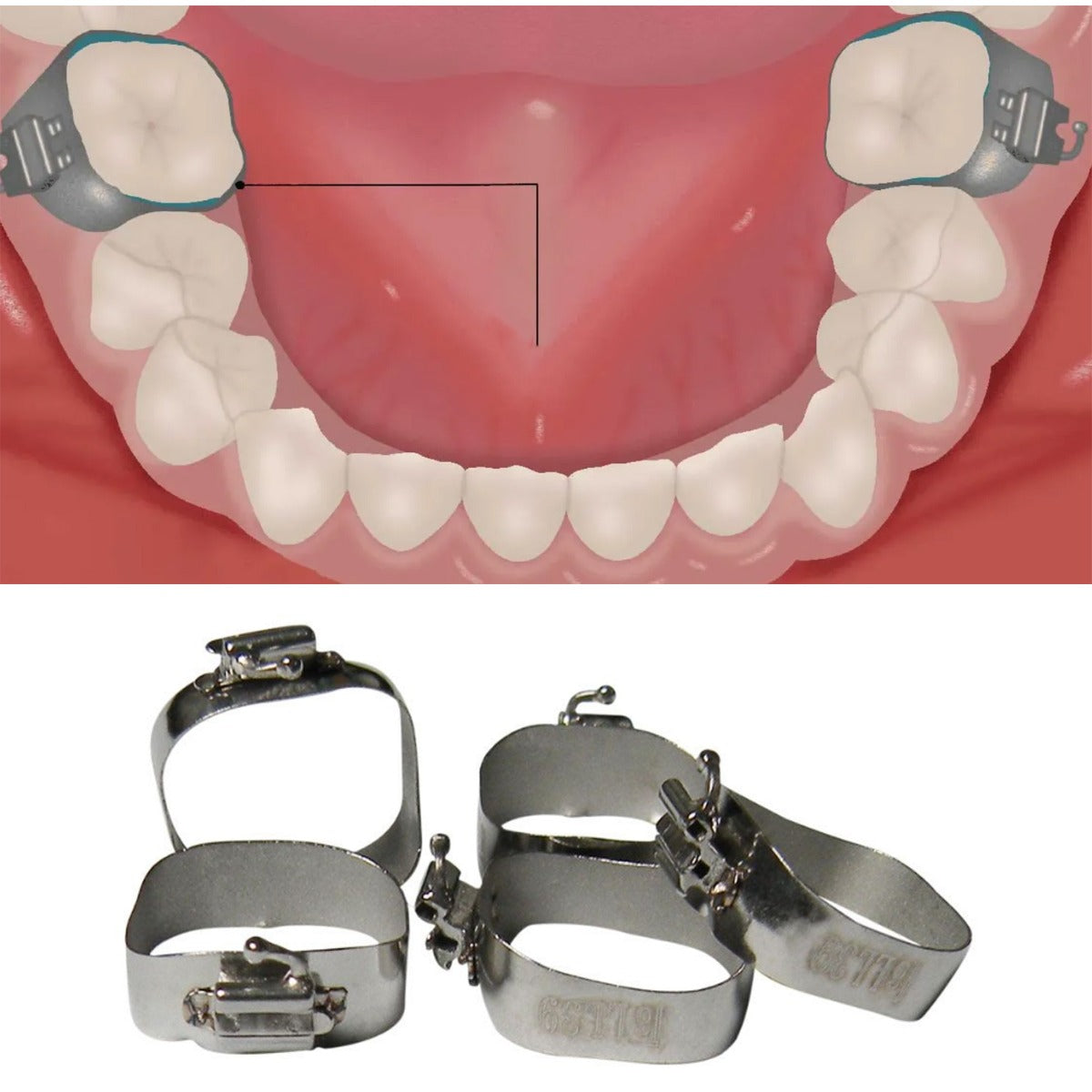 Centrino preformed molar bands with MBT 022 UDLS tubes, right side, in a 5-pack for orthodontic treatment.