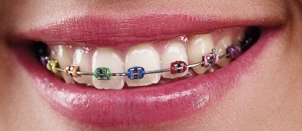 Dentaurum Equilibrium MBT and Roth metal brackets for orthodontic treatment, standard and mini sizes, by Dentaurum Orthodontics.