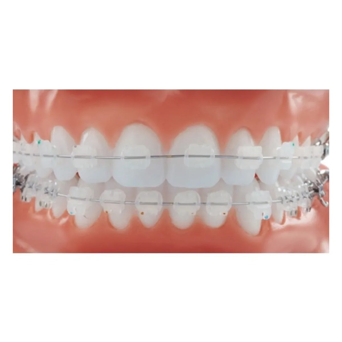 Fox Passive SLB Ceramic MBT 022 brackets kit featuring self-ligating orthodontic brackets for braces.