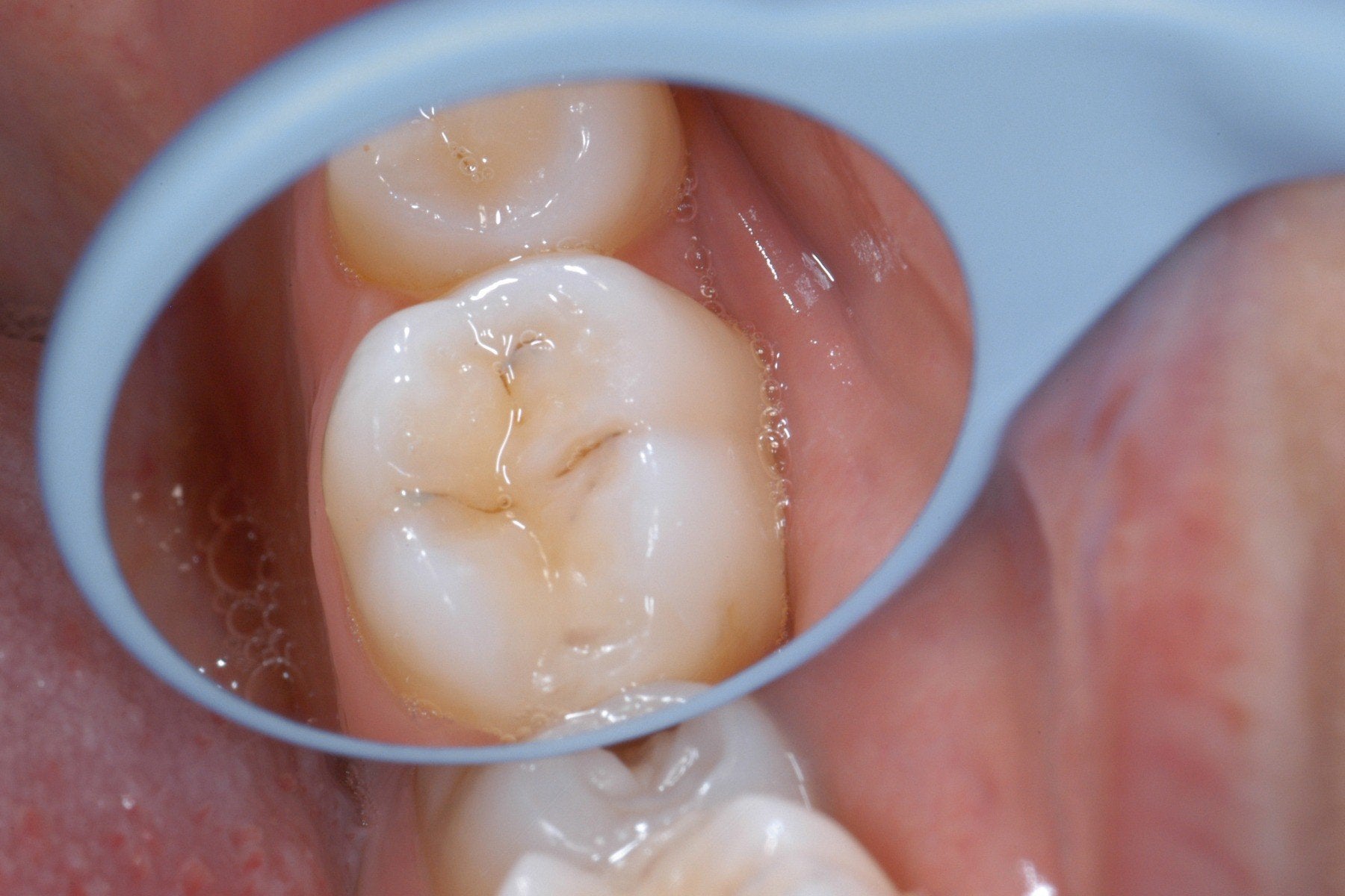 Assorted Hahnenkratt Relax Mouth Mirrors for dental diagnostics, featuring reflective surfaces for oral examination.