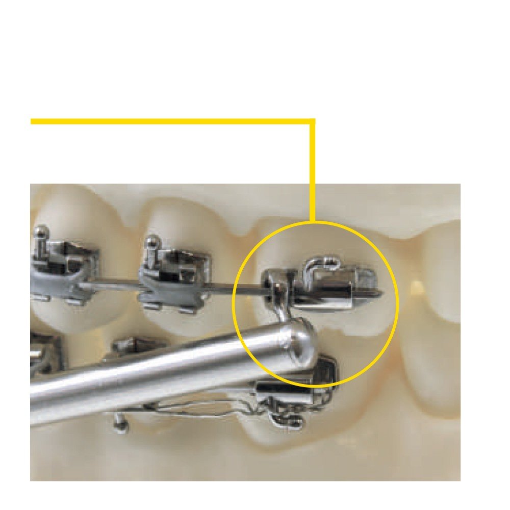 Leone N Class II Corrector with anterior eyelet, 35mm short, for orthodontic treatment, Leone s.p.a dental appliance, pair of two.