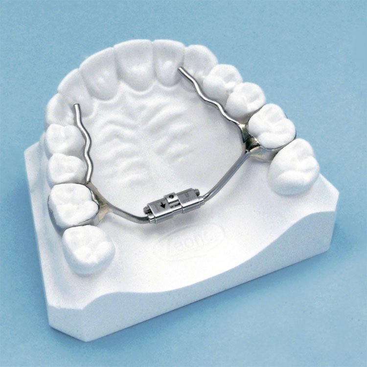 Leone s.p.a Rapid Micro Expander Screw for lower jaw, 11mm size, used in orthodontic treatment for expanding the dental arch.