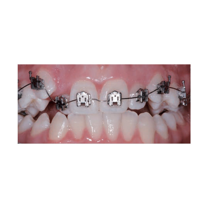 Leone F1000 Plus Damon 022 System passive self-ligating brackets kit shown, featuring orthodontic brackets for dental braces.