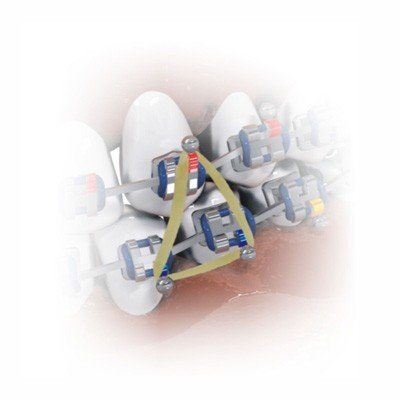 Morelli Medium intraoral latex elastics for orthodontic use, showing the elastic bands in a clear view.