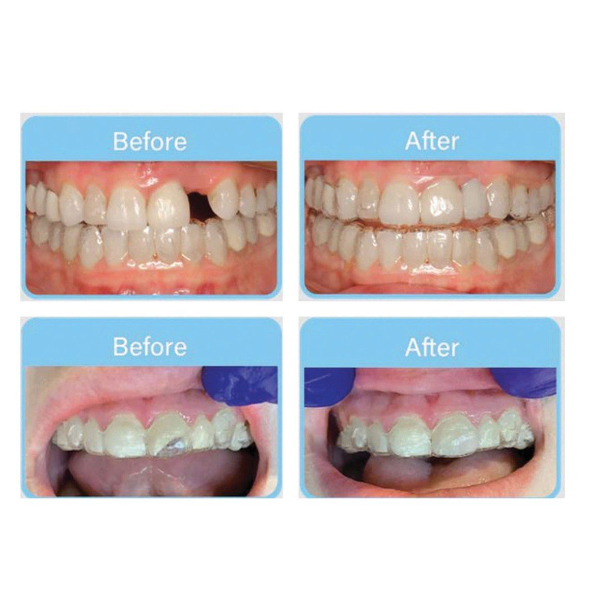 OrVance Aligner Pontics adhesive tube used for securing orthodontic aligner pontics in dental treatments.