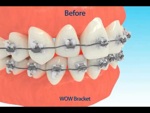 Osstem Majestry Ceramic SL Bracket from Osstem Orthodontics, aesthetic orthodontic bracket with inter-active design.
