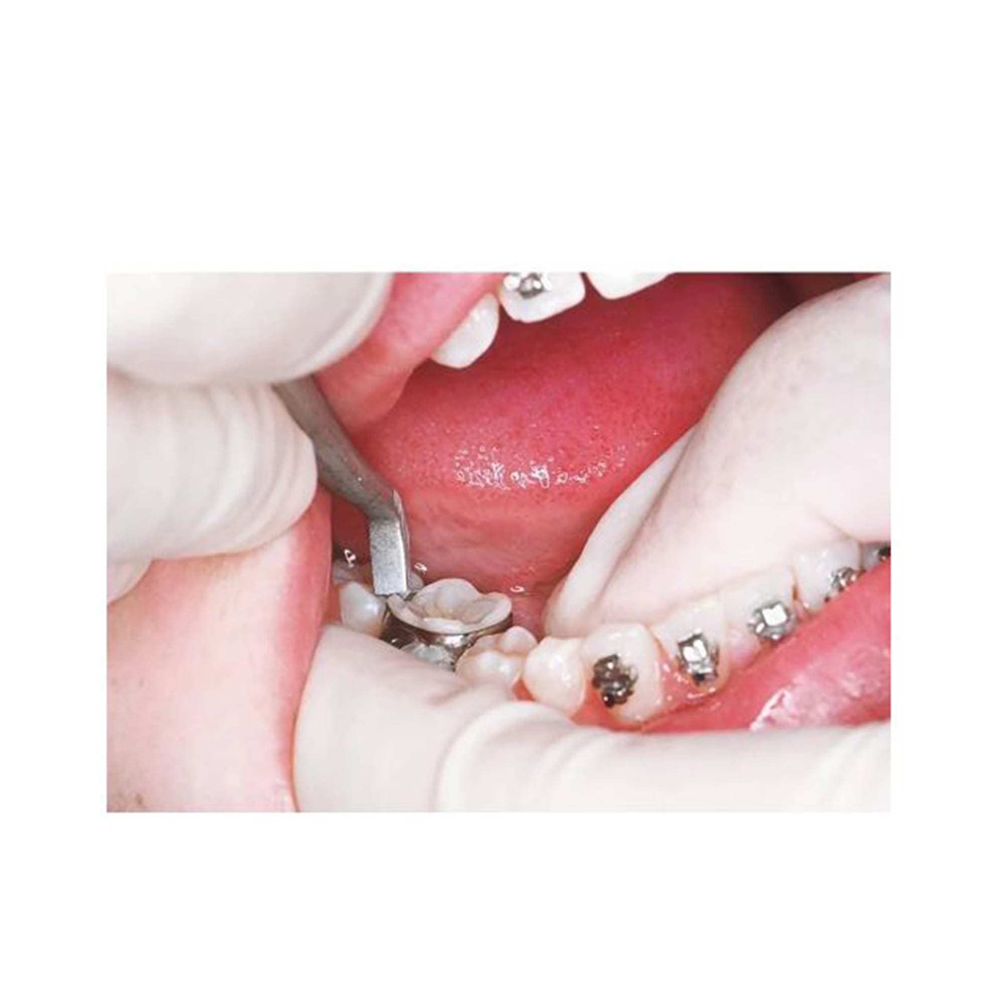 Shree Orthodontics band pusher with stainless steel handle used for orthodontic banding procedures
