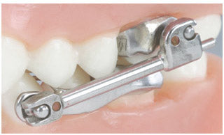 TP Orthodontics Herbst Appliance with flip-lock mechanism, showing the orthodontic appliance for jaw correction.
