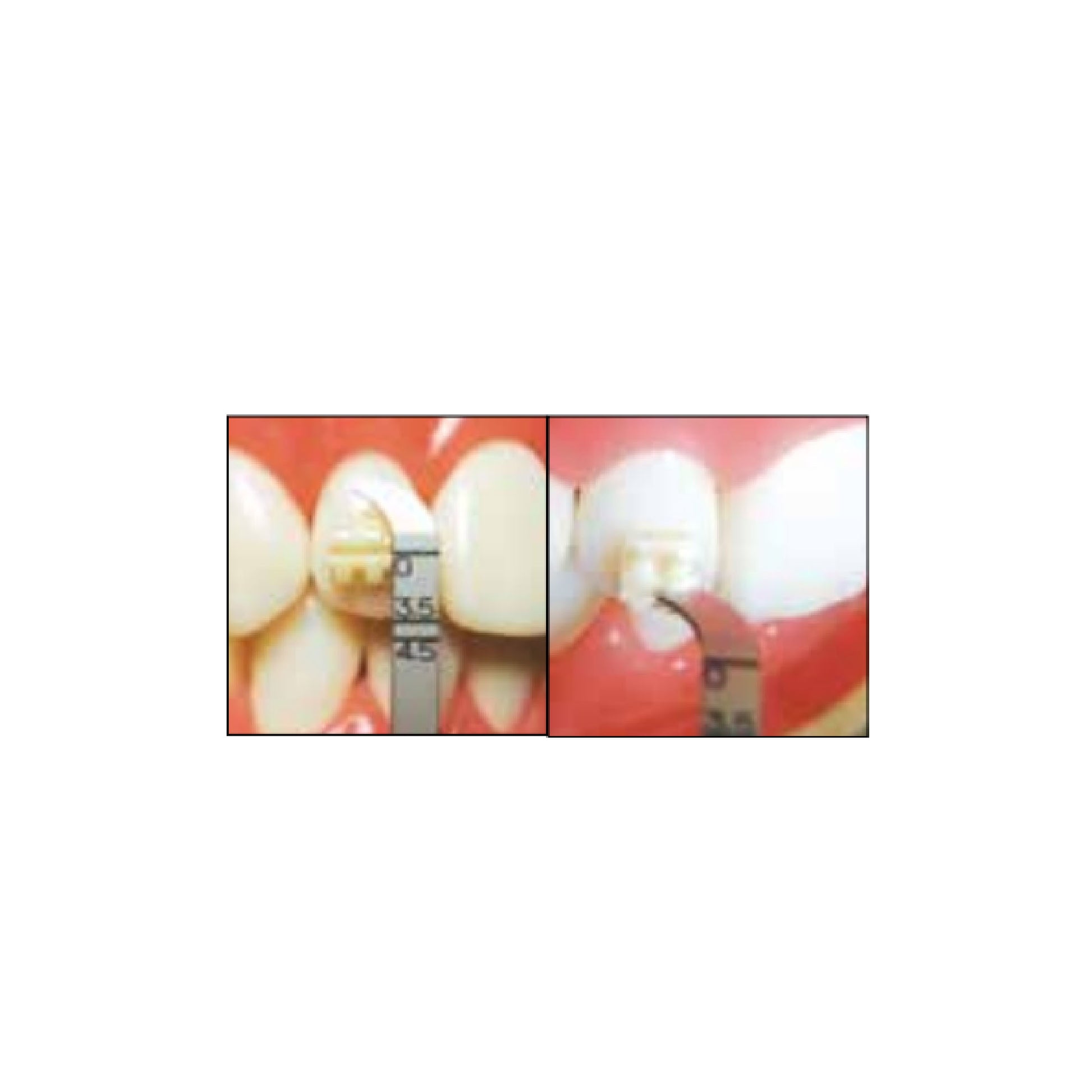 YDM Bracket Tweezer with Placer, precision forceps and tweezers for delicate handling and placement in technical tasks.